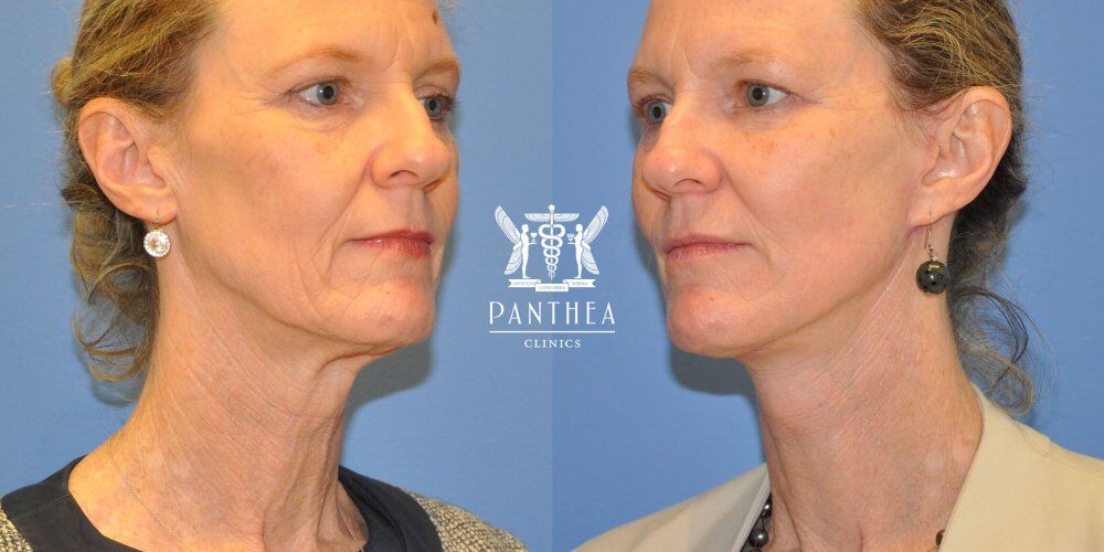 Neck Lift Cost Sydney How much does a neck lift procedure cost